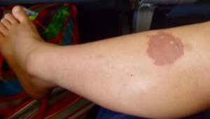 629 モロッコサソリ刺された傷 アップ